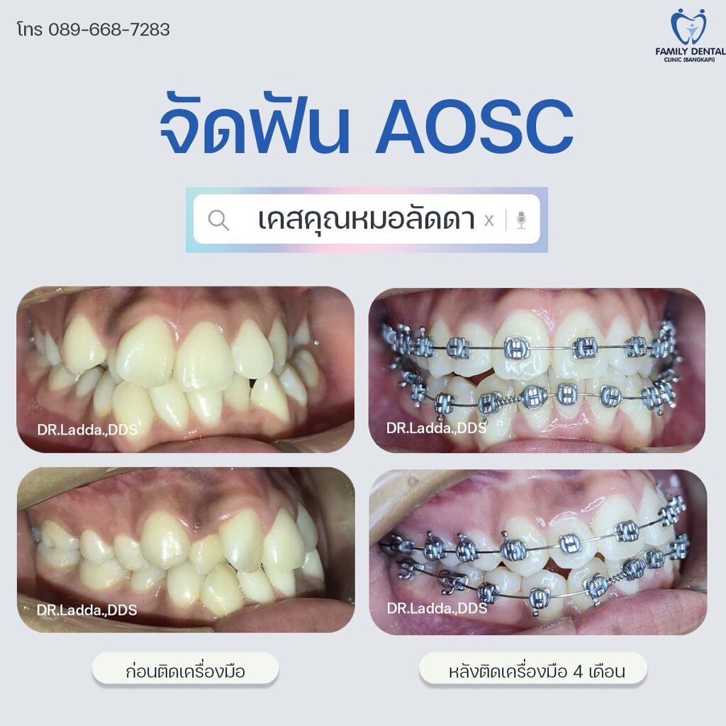 จัดฟัน AOSC 4เดือน